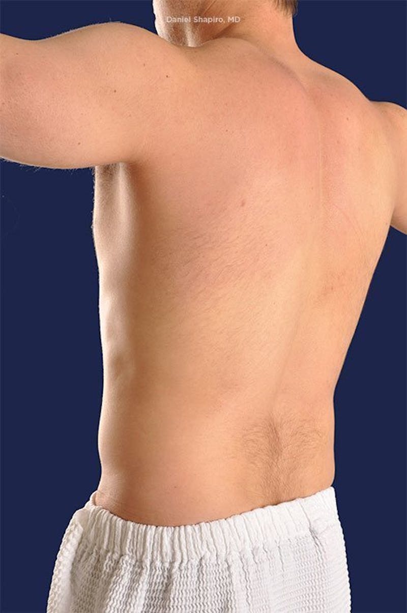 Hi-Def Liposuction Before & After Gallery - Patient 18264962 - Image 7