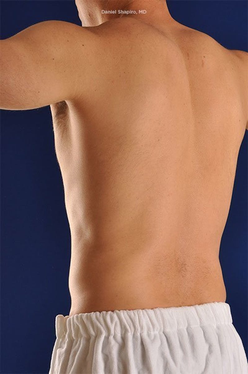 Male Hi-Def Liposuction Before & After Gallery - Patient 18258839 - Image 8