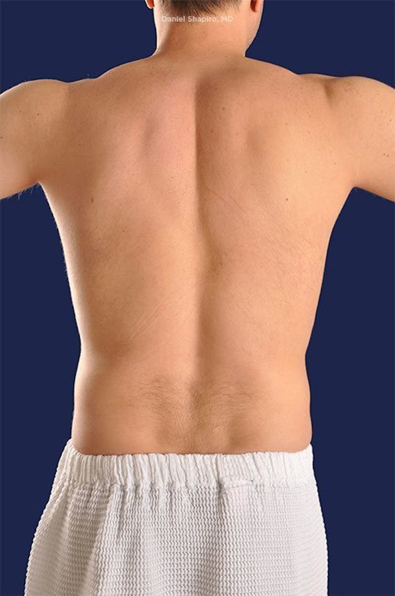 Male Hi-Def Liposuction Before & After Gallery - Patient 18258839 - Image 9