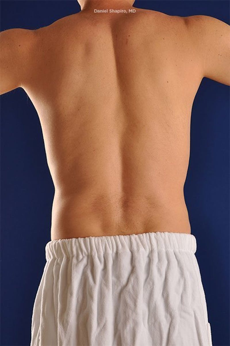Male Hi-Def Liposuction Before & After Gallery - Patient 18258839 - Image 10