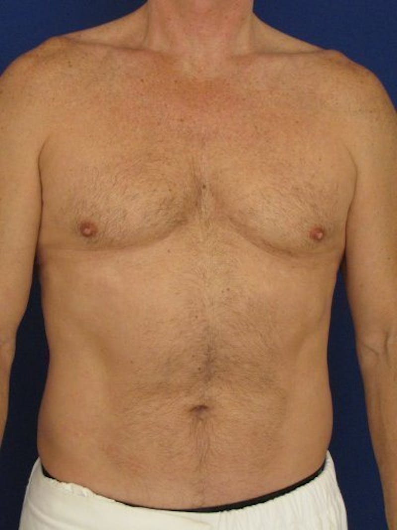 Male Hi-Def Liposuction Before & After Gallery - Patient 18258843 - Image 1