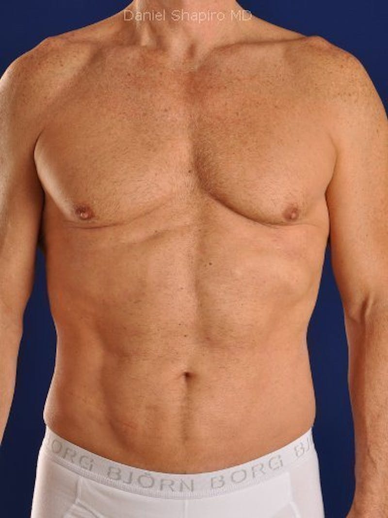 Male Hi-Def Liposuction Before & After Gallery - Patient 18258843 - Image 2