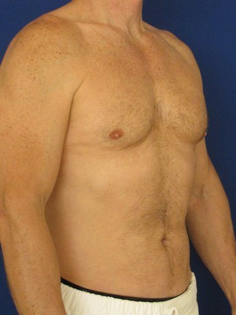 Male Hi-Def Liposuction Before & After Gallery - Patient 18258843 - Image 3