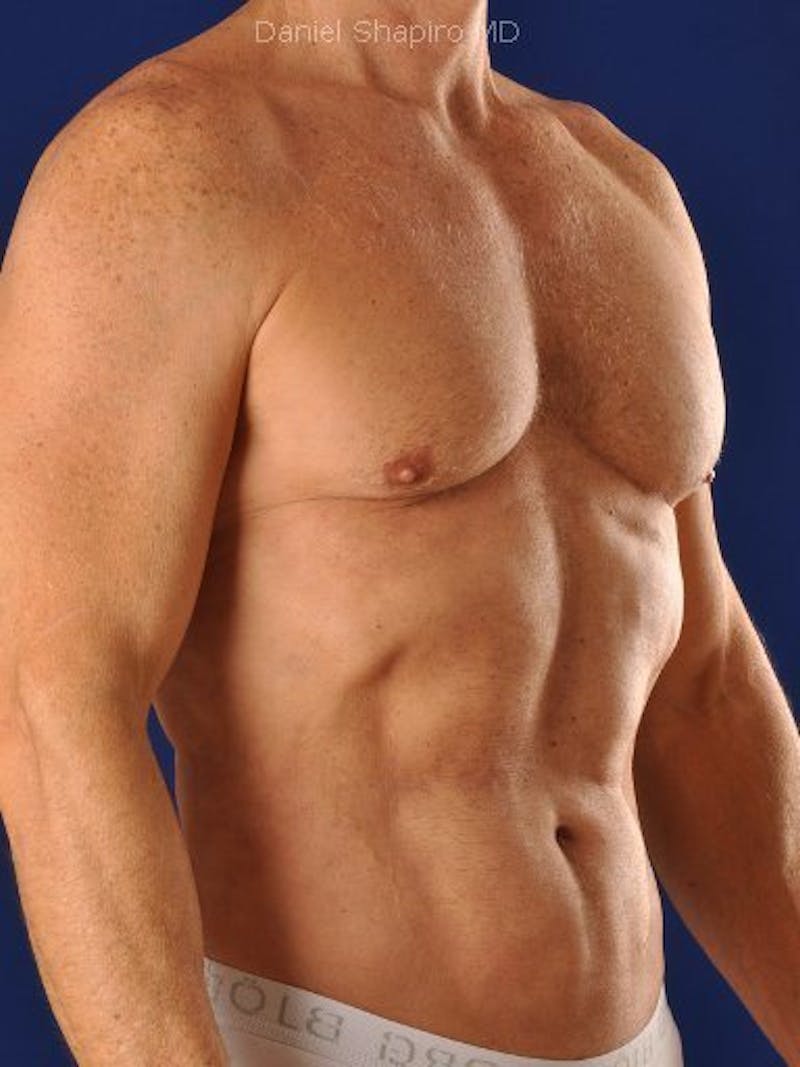 Male Hi-Def Liposuction Before & After Gallery - Patient 18258843 - Image 4
