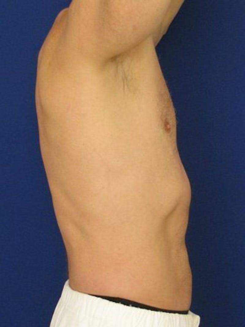 Male Hi-Def Liposuction Before & After Gallery - Patient 18258843 - Image 5