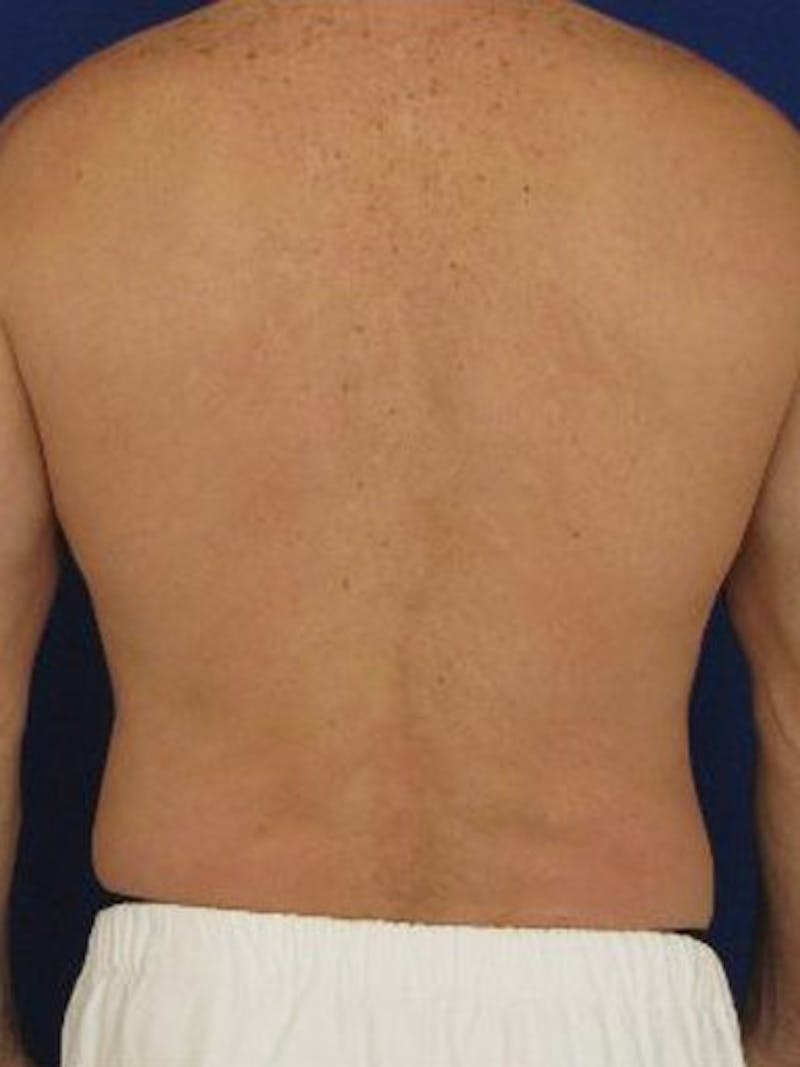 Male Hi-Def Liposuction Before & After Gallery - Patient 18258843 - Image 7