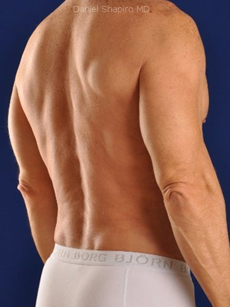 Male Hi-Def Liposuction Before & After Gallery - Patient 18258843 - Image 8