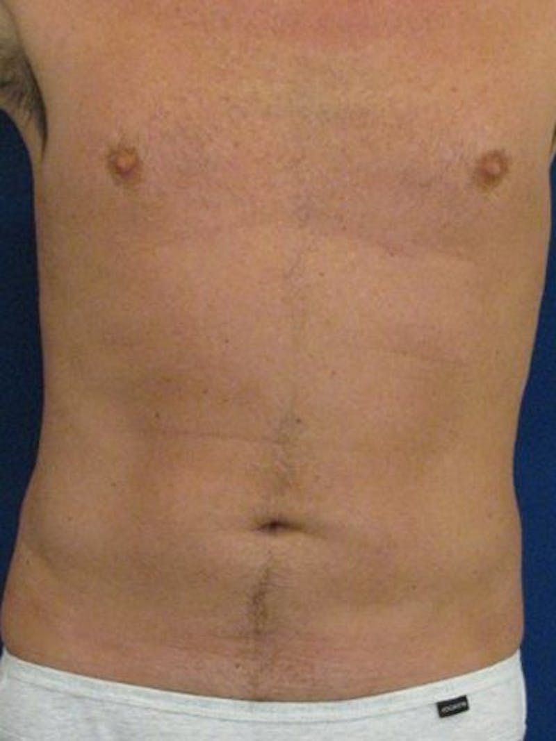 Male Hi-Def Liposuction Before & After Gallery - Patient 18258849 - Image 1