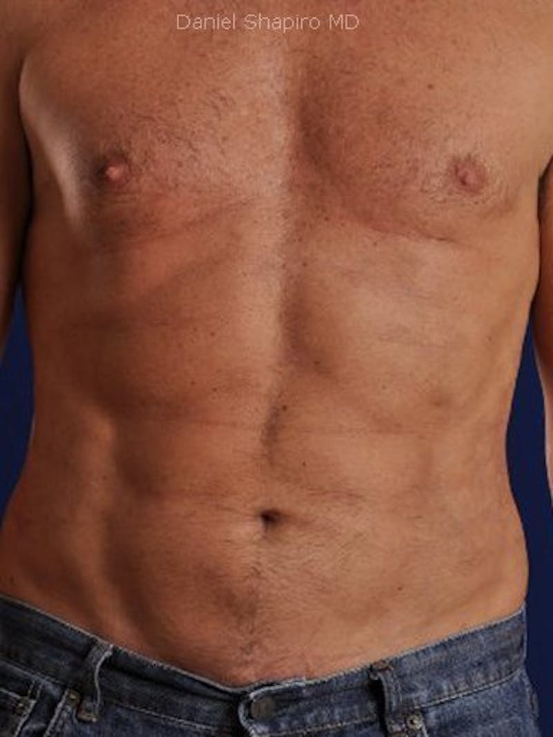Male Hi-Def Liposuction Before & After Gallery - Patient 18258849 - Image 2