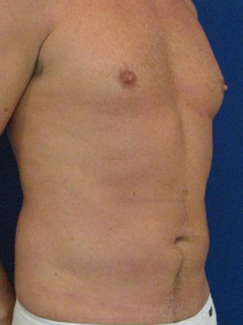 Hi-Def Liposuction Before & After Gallery - Patient 18264964 - Image 3