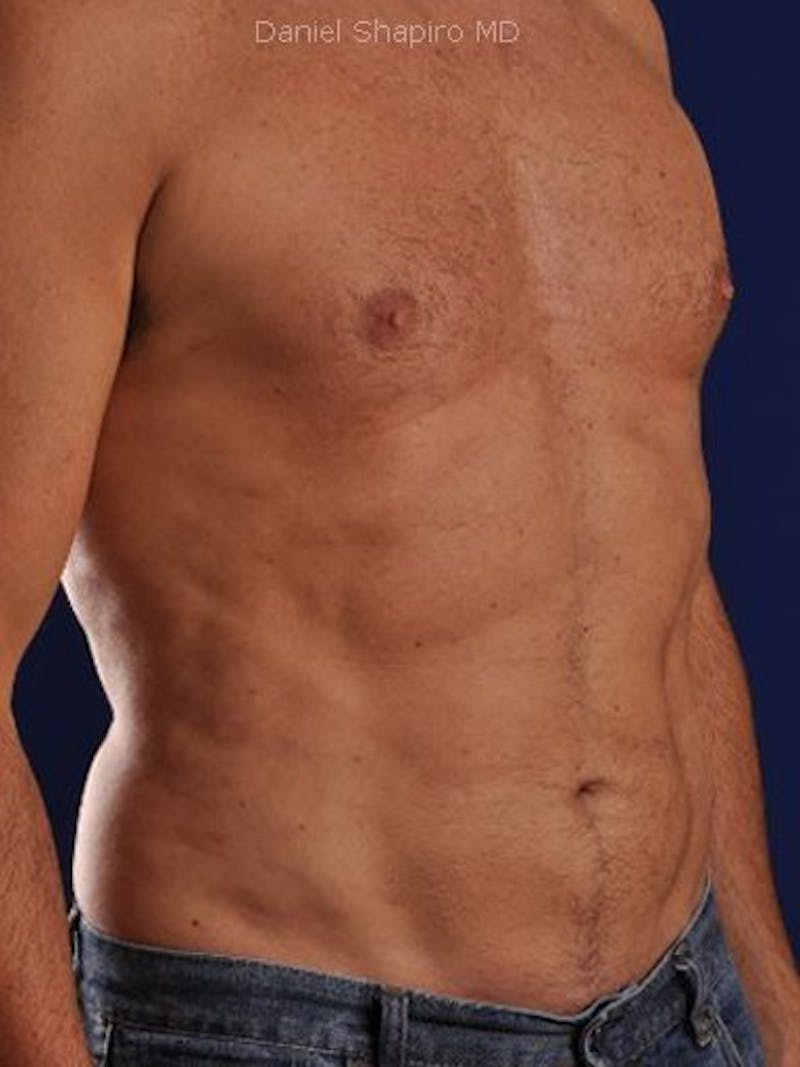 Male Hi-Def Liposuction Before & After Gallery - Patient 18258849 - Image 4