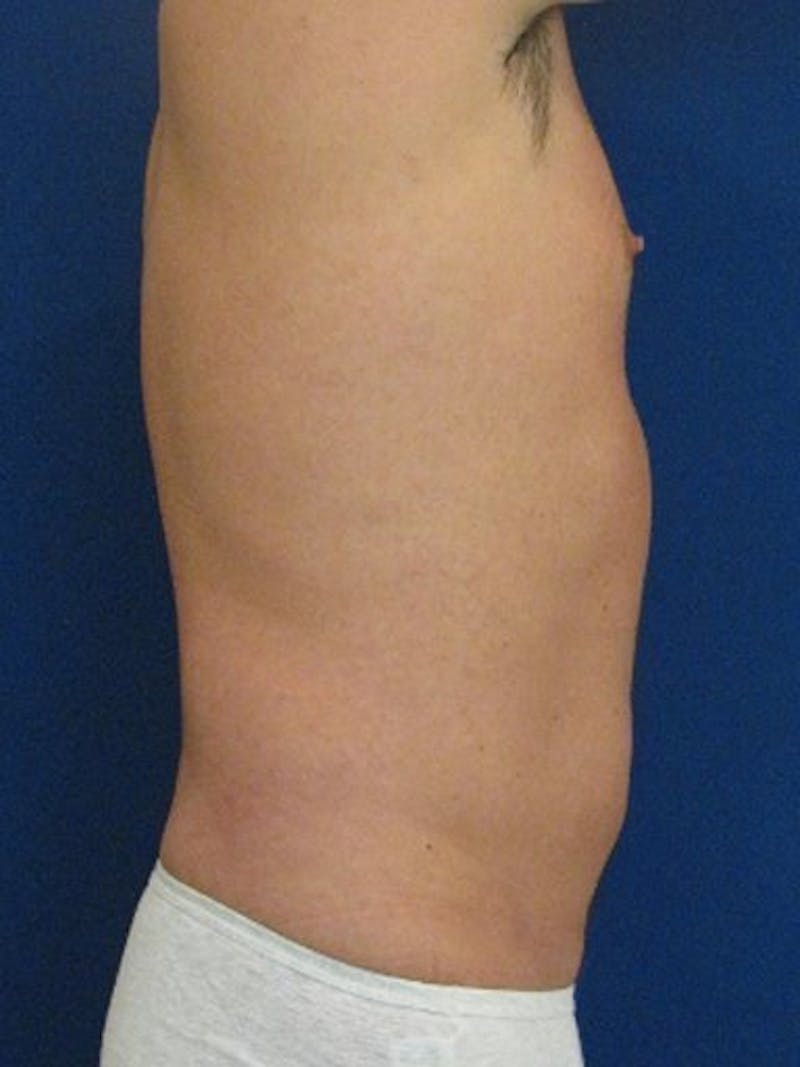 Male Hi-Def Liposuction Before & After Gallery - Patient 18258849 - Image 5