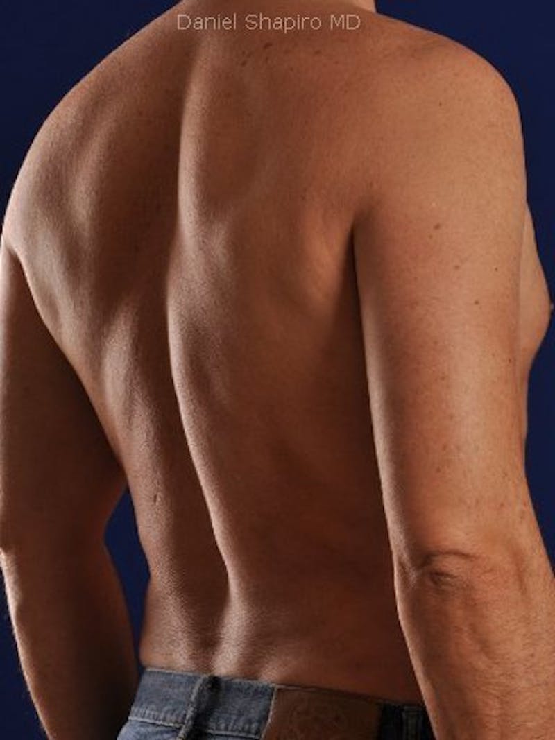 Male Hi-Def Liposuction Before & After Gallery - Patient 18258849 - Image 6
