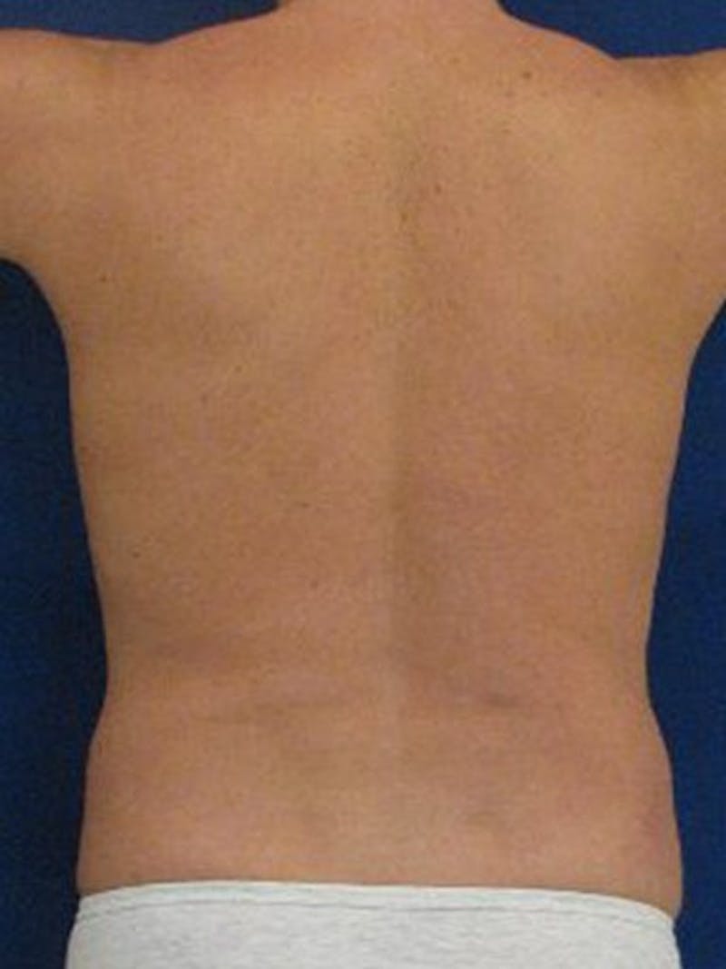 Male Hi-Def Liposuction Before & After Gallery - Patient 18258849 - Image 7