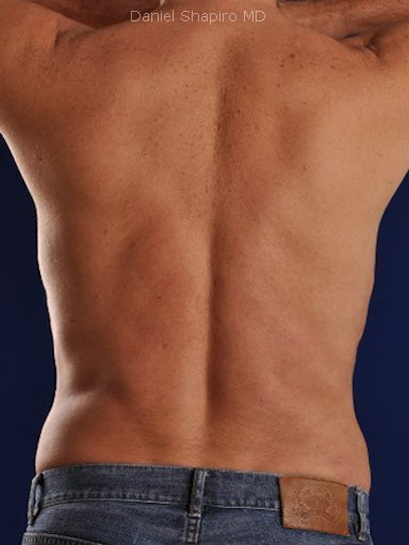 Male Hi-Def Liposuction Before & After Gallery - Patient 18258849 - Image 8