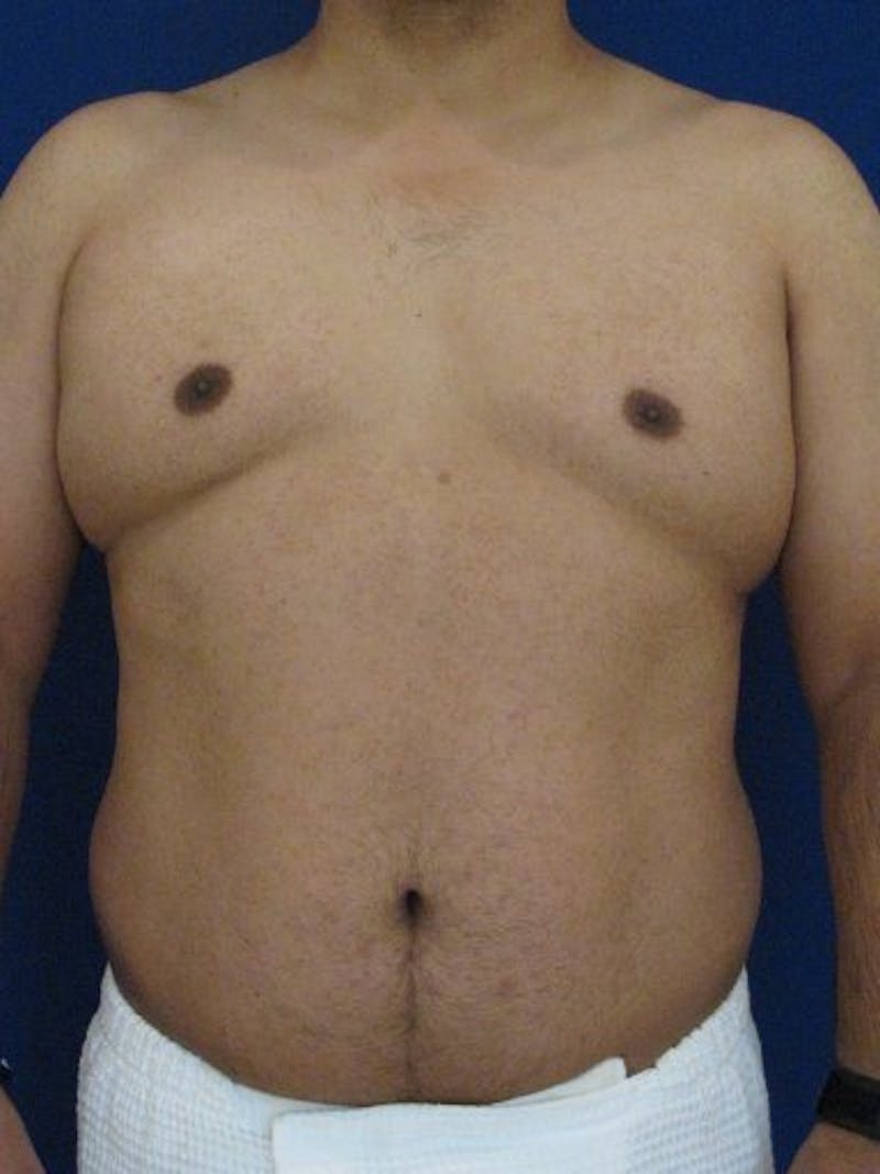 Hi-Def Liposuction Before & After Gallery - Patient 18264965 - Image 1