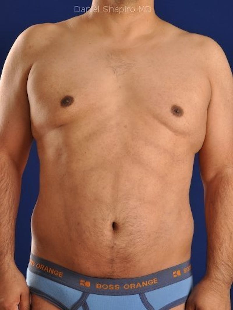 Male Hi-Def Liposuction Before & After Gallery - Patient 18259255 - Image 2