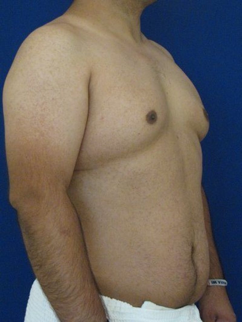 Male Hi-Def Liposuction Before & After Gallery - Patient 18259255 - Image 3