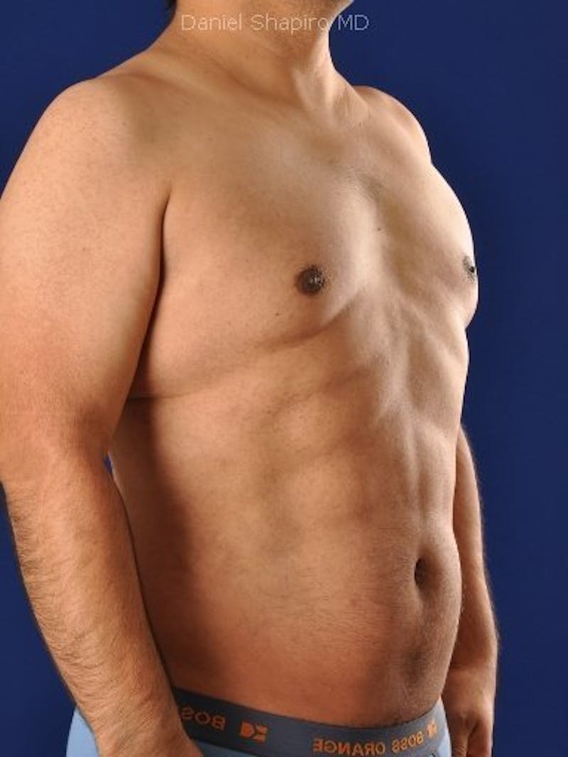 Male Hi-Def Liposuction Before & After Gallery - Patient 18259255 - Image 4
