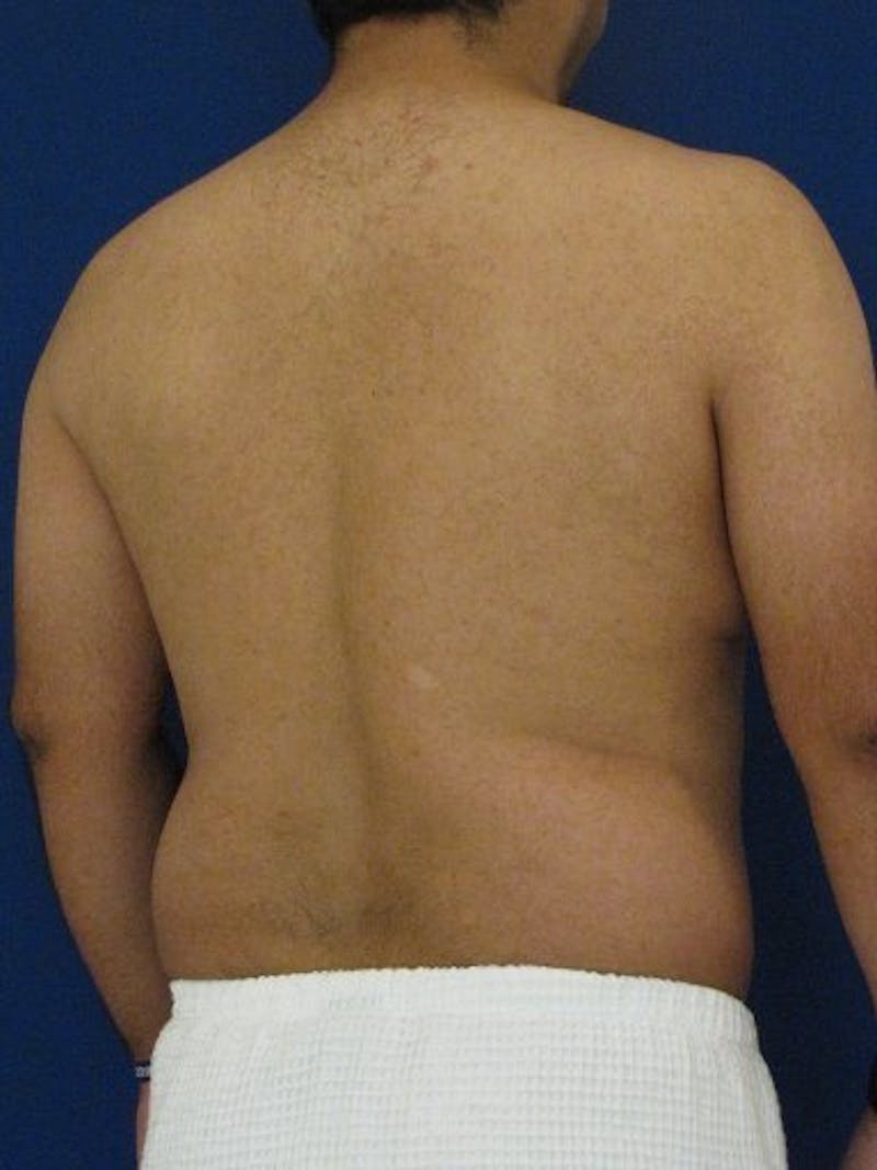 Male Hi-Def Liposuction Before & After Gallery - Patient 18259255 - Image 5