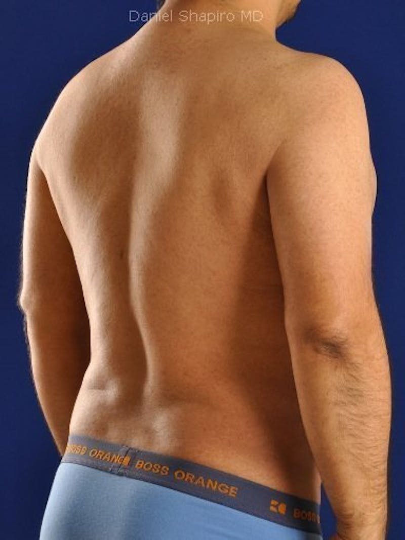 Male Hi-Def Liposuction Before & After Gallery - Patient 18259255 - Image 6