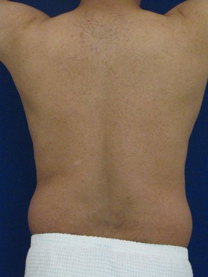 Male Hi-Def Liposuction Before & After Gallery - Patient 18259255 - Image 7