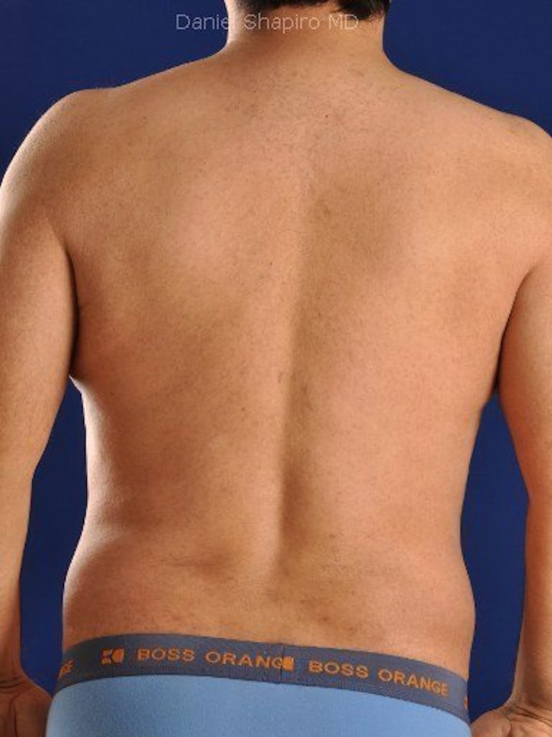 Male Hi-Def Liposuction Before & After Gallery - Patient 18259255 - Image 8