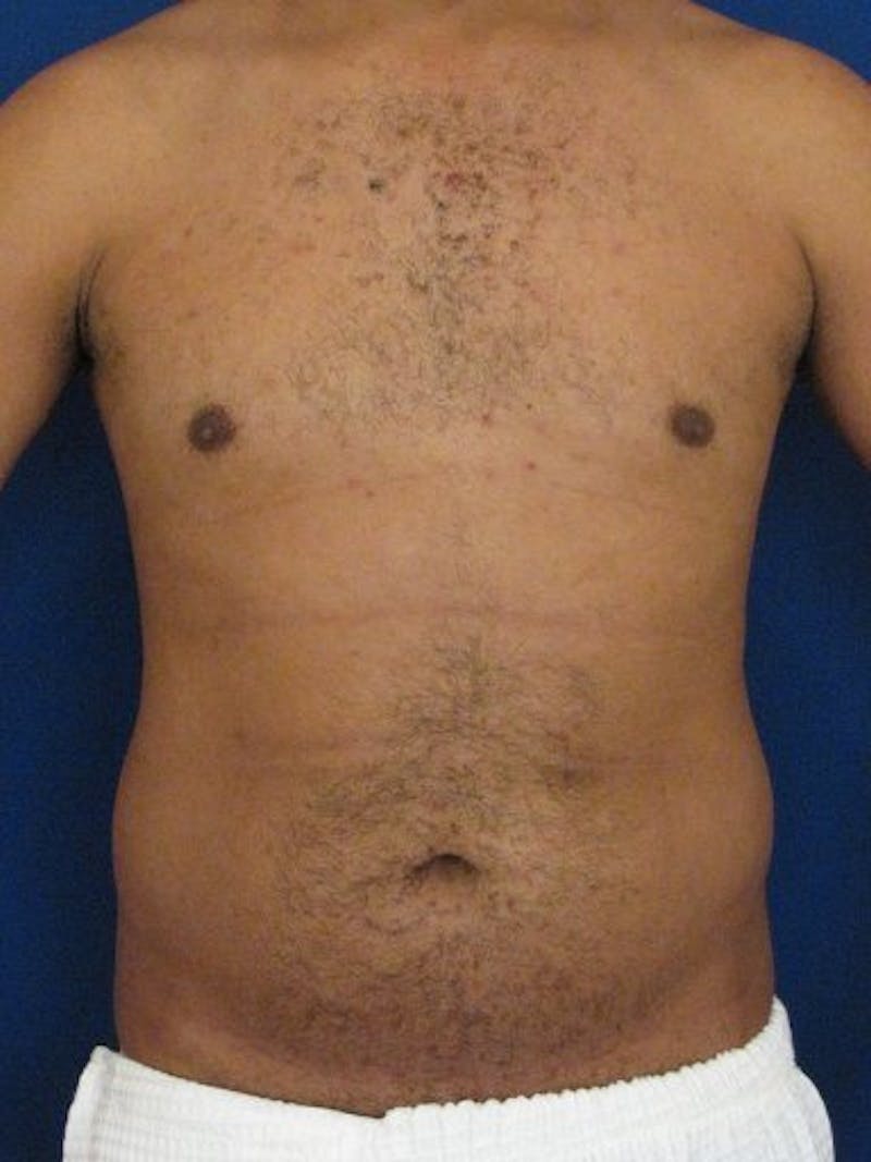 Male Hi-Def Liposuction Before & After Gallery - Patient 18259261 - Image 1