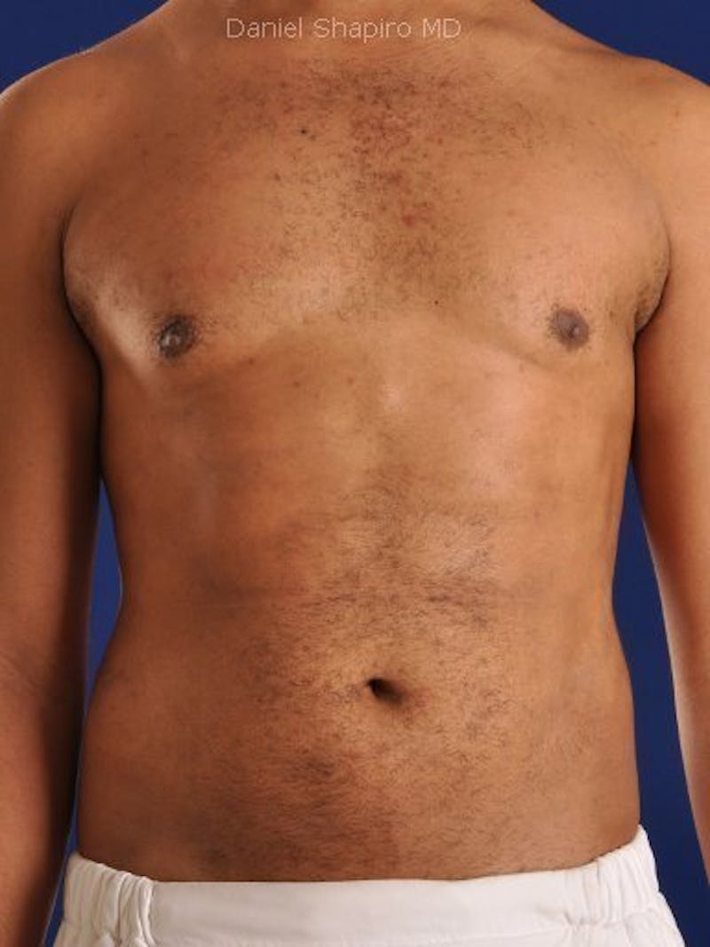 Male Hi-Def Liposuction Before & After Gallery - Patient 18259261 - Image 2