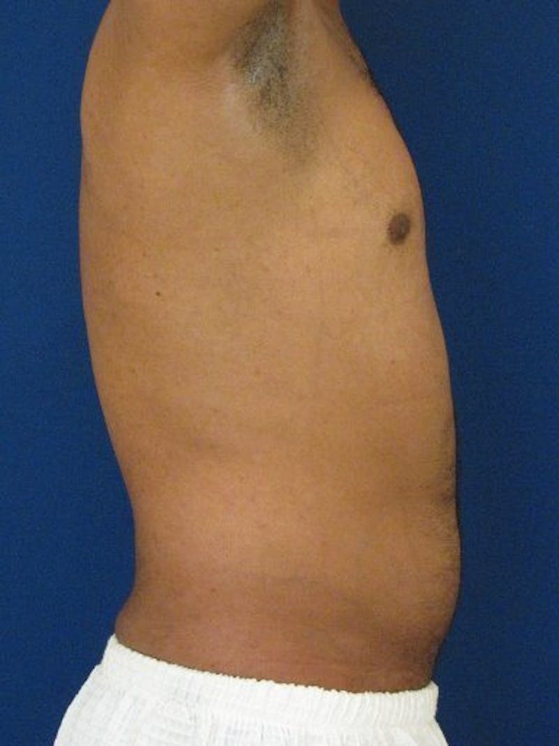 Male Hi-Def Liposuction Before & After Gallery - Patient 18259261 - Image 3