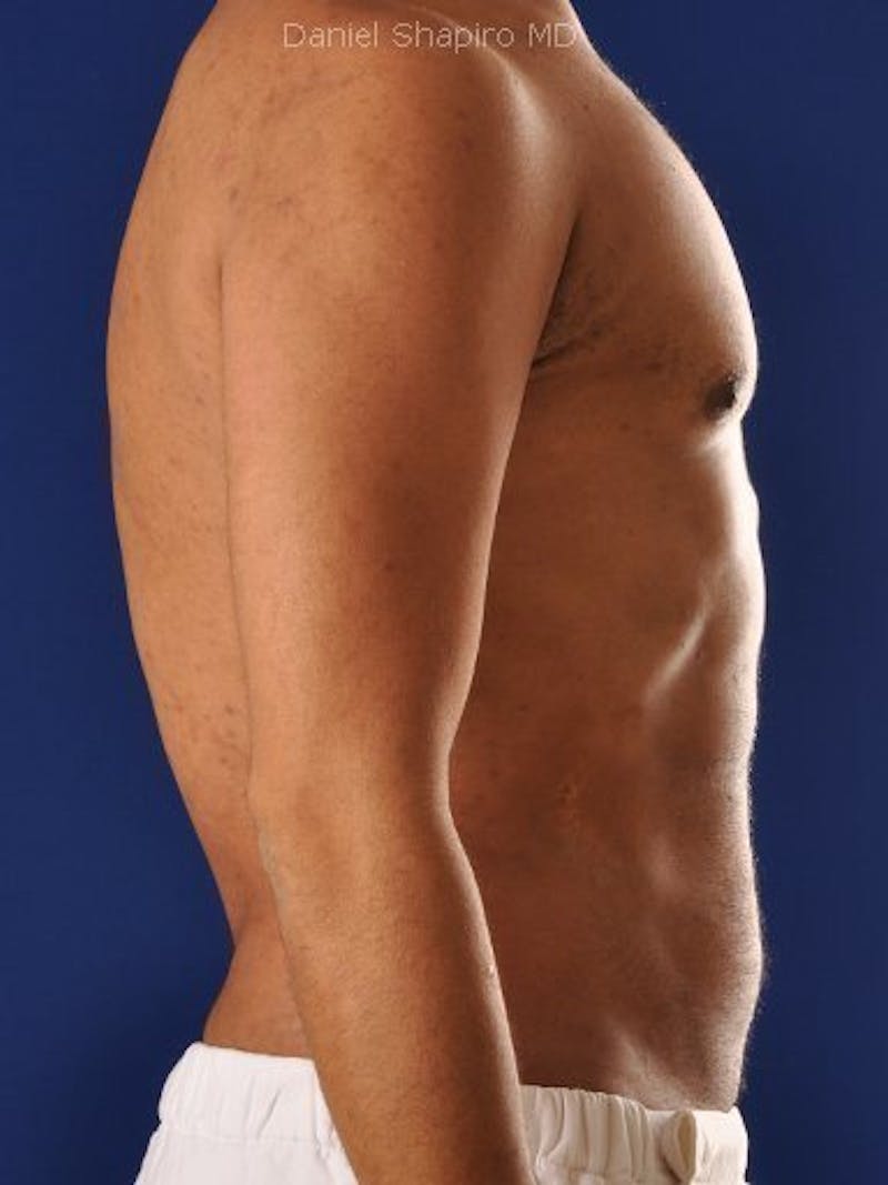 Hi-Def Liposuction Before & After Gallery - Patient 18264966 - Image 4