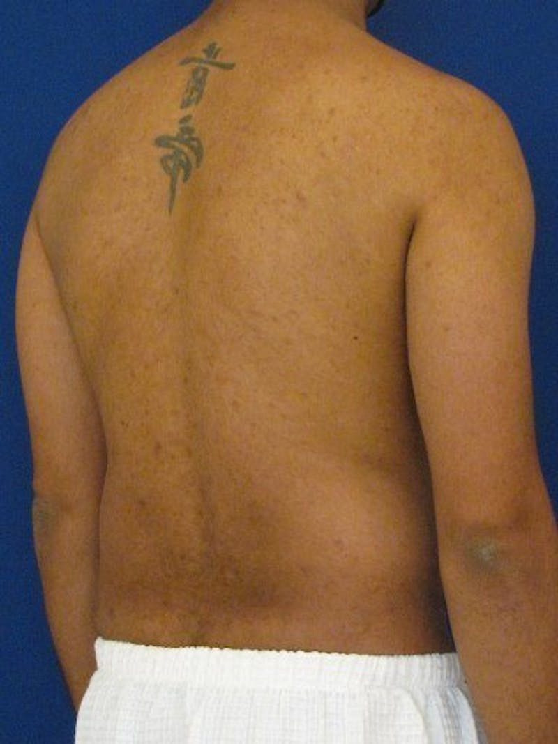 Male Hi-Def Liposuction Before & After Gallery - Patient 18259261 - Image 5