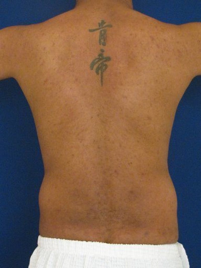 Male Hi-Def Liposuction Before & After Gallery - Patient 18259261 - Image 7
