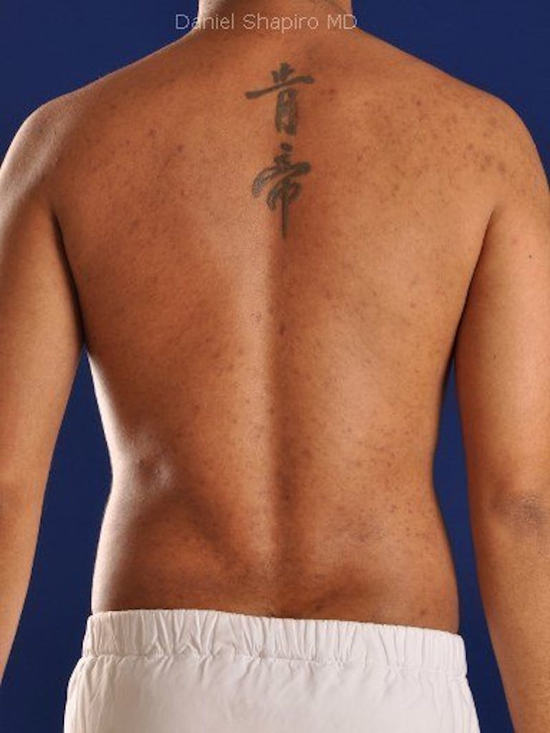 Male Hi-Def Liposuction Before & After Gallery - Patient 18259261 - Image 8