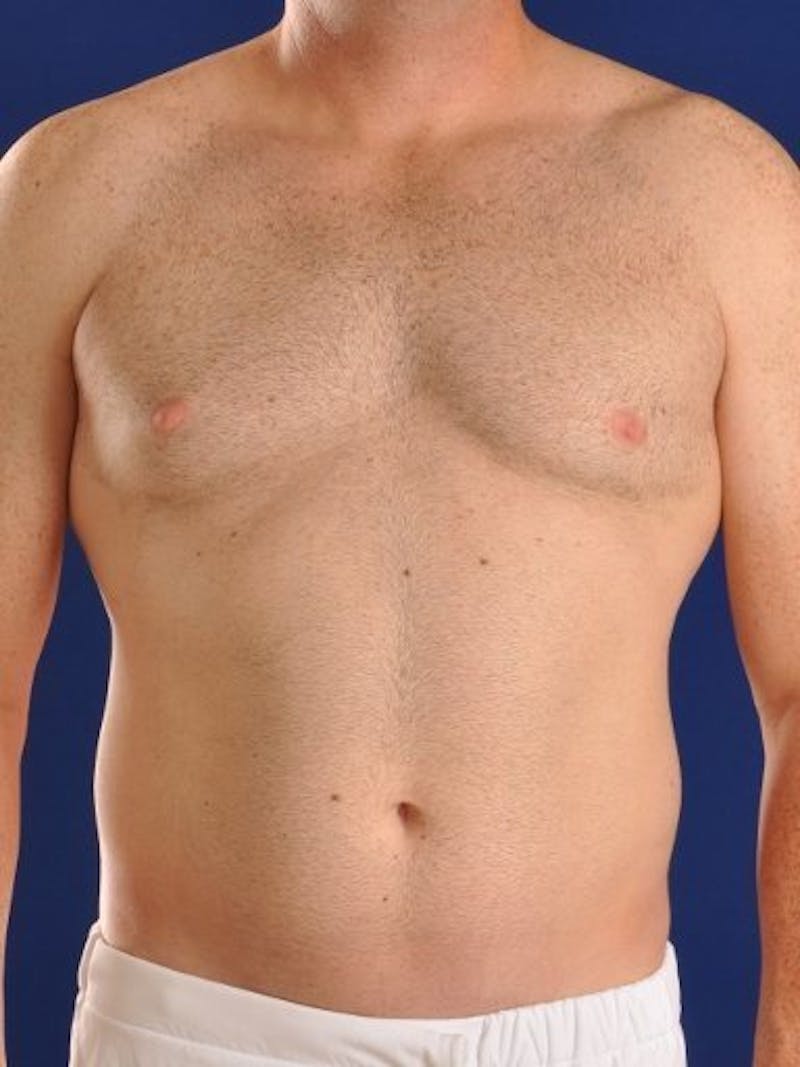 Male Hi-Def Liposuction Before & After Gallery - Patient 18260023 - Image 1