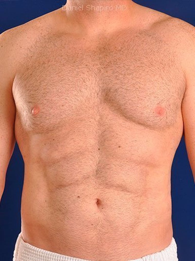 Male Hi-Def Liposuction Before & After Gallery - Patient 18260023 - Image 2