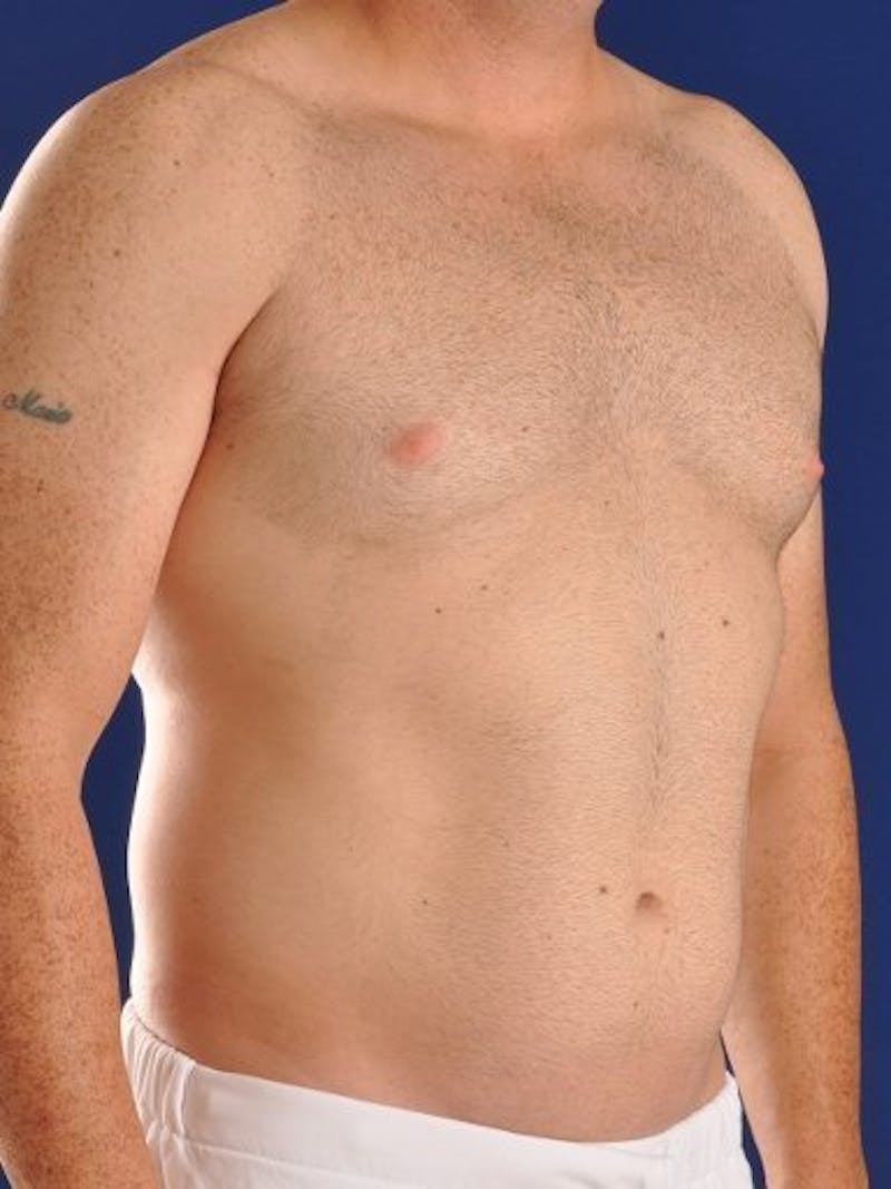 Male Hi-Def Liposuction Before & After Gallery - Patient 18260023 - Image 3