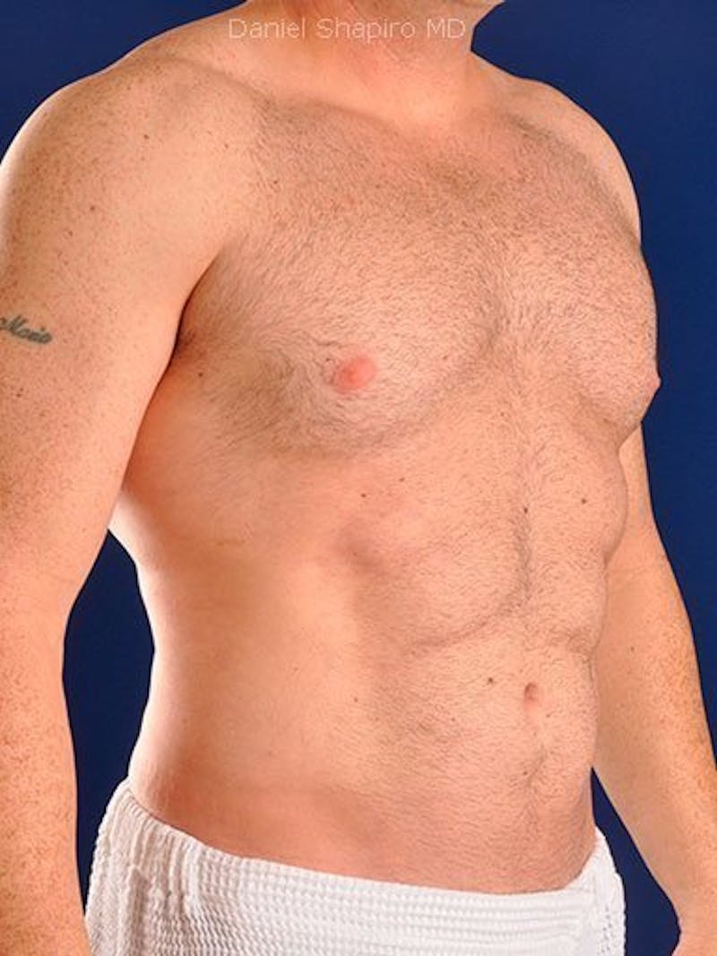 Male Hi-Def Liposuction Before & After Gallery - Patient 18260023 - Image 4