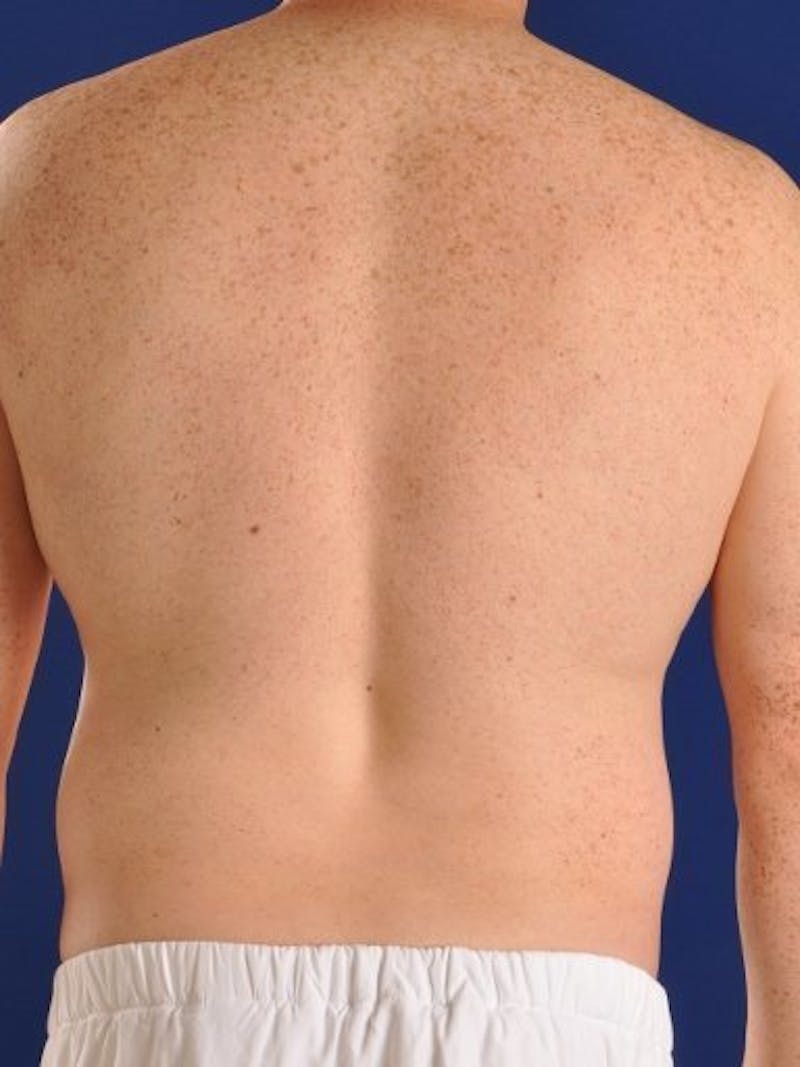 Hi-Def Liposuction Before & After Gallery - Patient 18264967 - Image 5