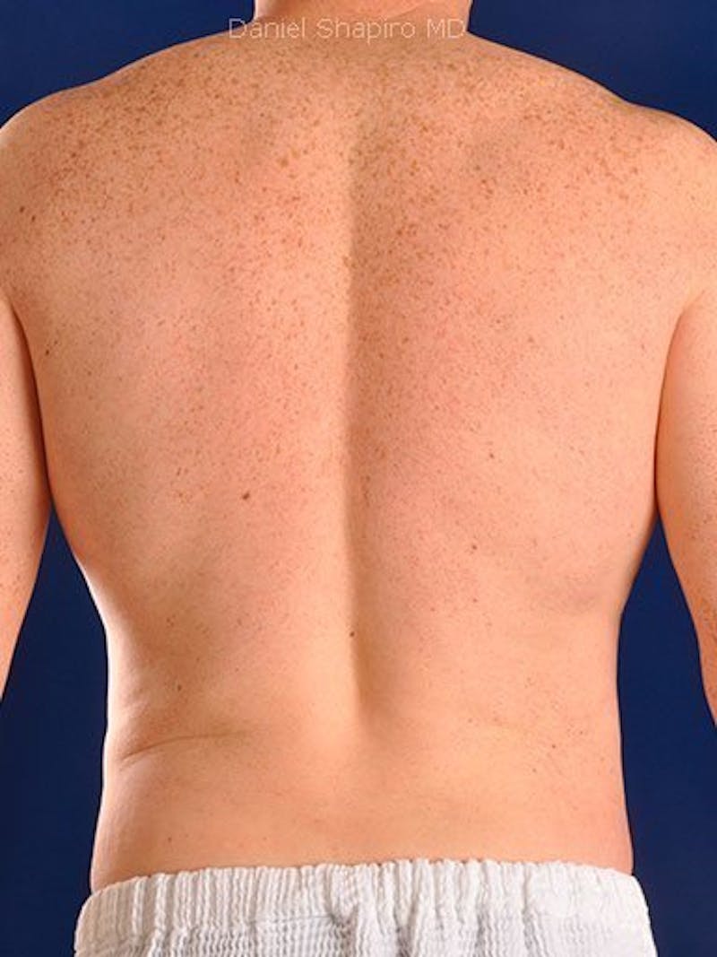 Male Hi-Def Liposuction Before & After Gallery - Patient 18260023 - Image 6
