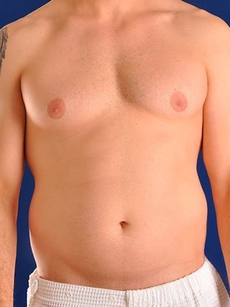 Male Hi-Def Liposuction Before & After Gallery - Patient 18260030 - Image 1