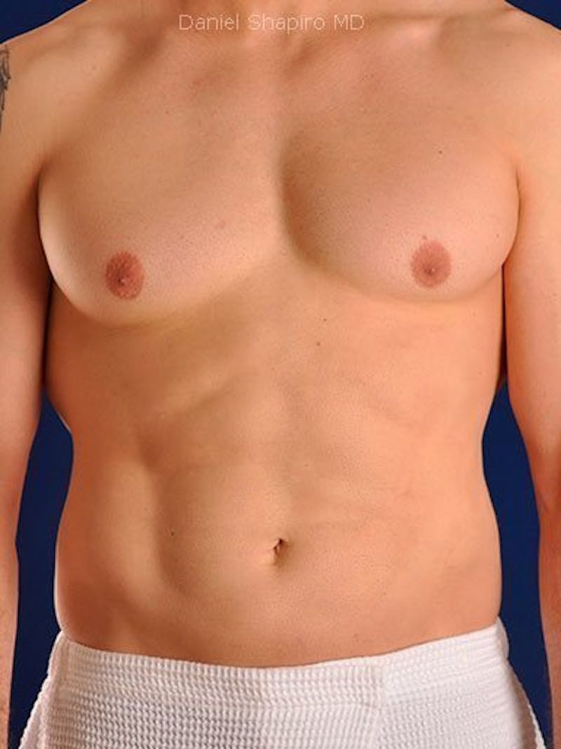Male Hi-Def Liposuction Before & After Gallery - Patient 18260030 - Image 2