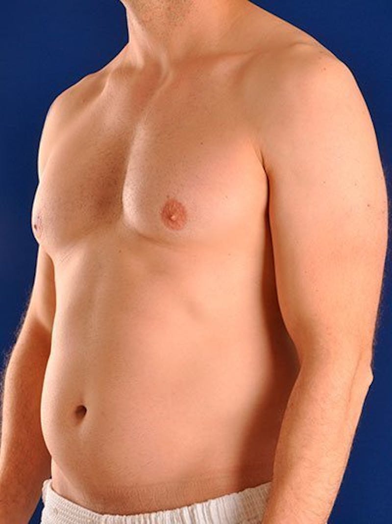 Male Hi-Def Liposuction Before & After Gallery - Patient 18260030 - Image 3