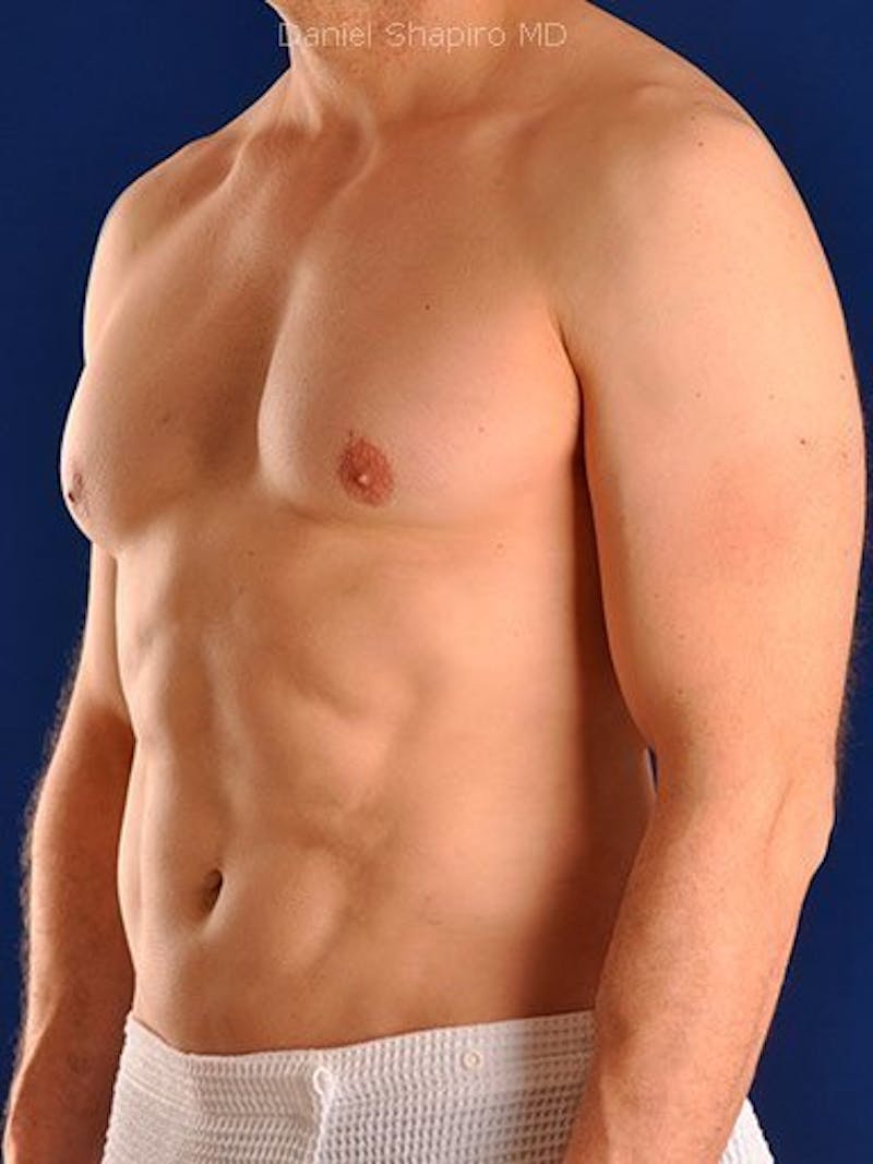 Male Hi-Def Liposuction Before & After Gallery - Patient 18260030 - Image 4