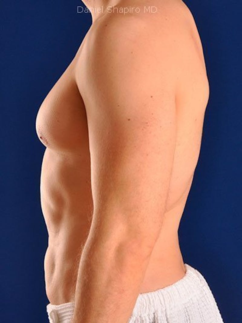 Male Hi-Def Liposuction Before & After Gallery - Patient 18260030 - Image 6