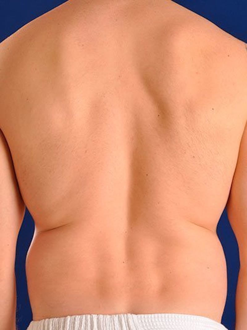 Male Hi-Def Liposuction Before & After Gallery - Patient 18260030 - Image 7