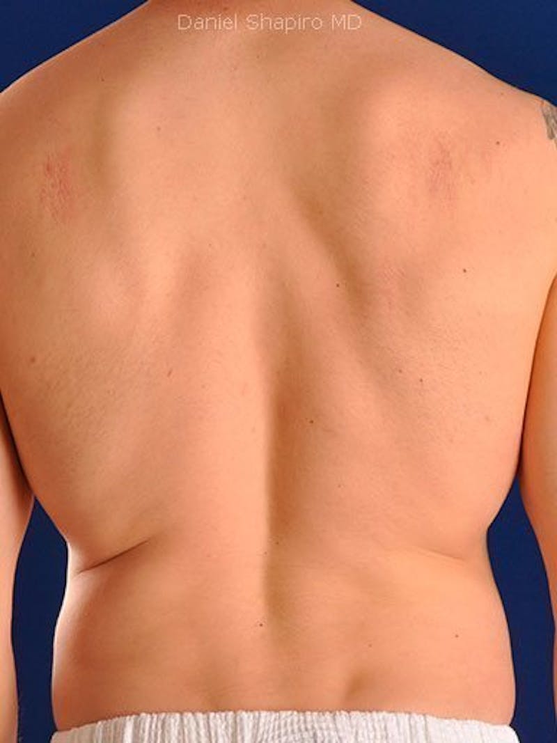 Male Hi-Def Liposuction Before & After Gallery - Patient 18260030 - Image 8