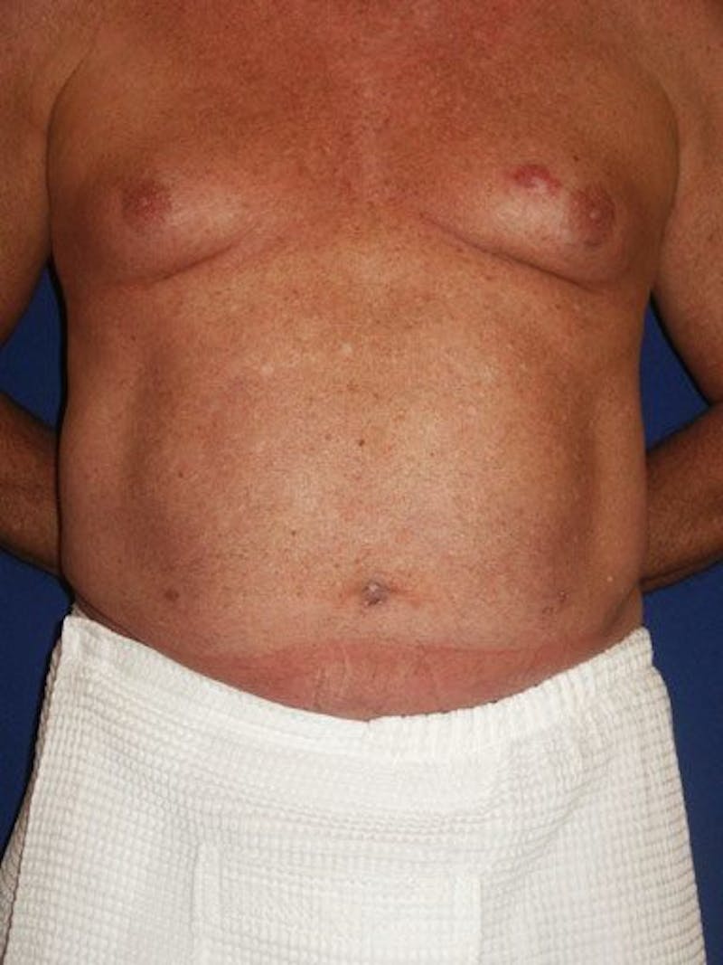 Male Hi-Def Liposuction Before & After Gallery - Patient 18260031 - Image 1