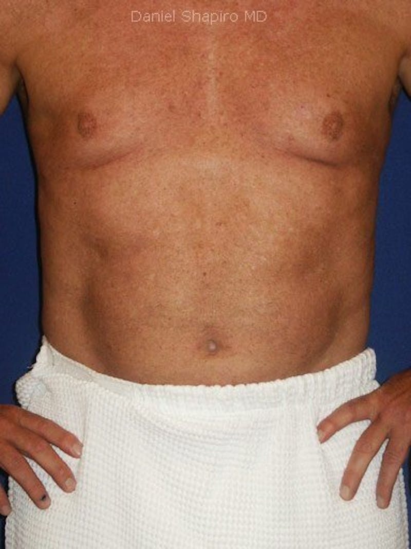 Male Hi-Def Liposuction Before & After Gallery - Patient 18260031 - Image 2