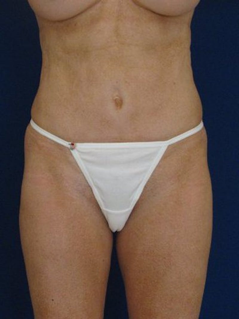 Female Hi-Def Liposuction Before & After Gallery - Patient 18260508 - Image 1